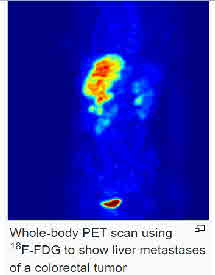 Typical-PetScan-ColonTumor